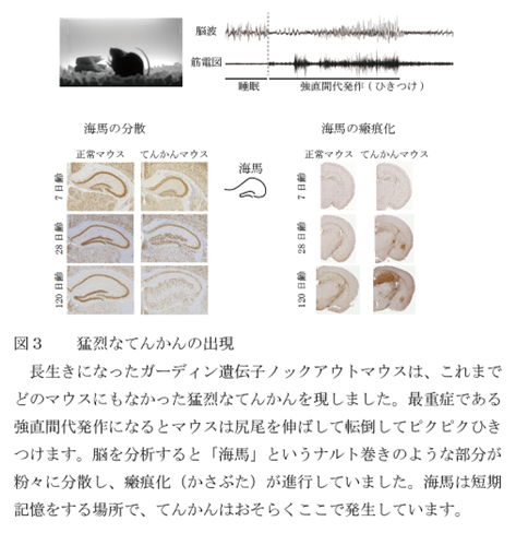 猛烈なてんかんの出現